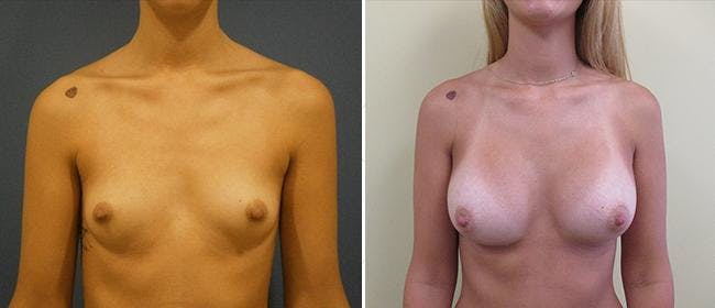 Breast Augmentation Before & After Gallery - Patient 38566555 - Image 1