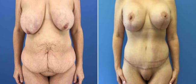 Abdominoplasty (Tummy Tuck) Before & After Gallery - Patient 38566556 - Image 1