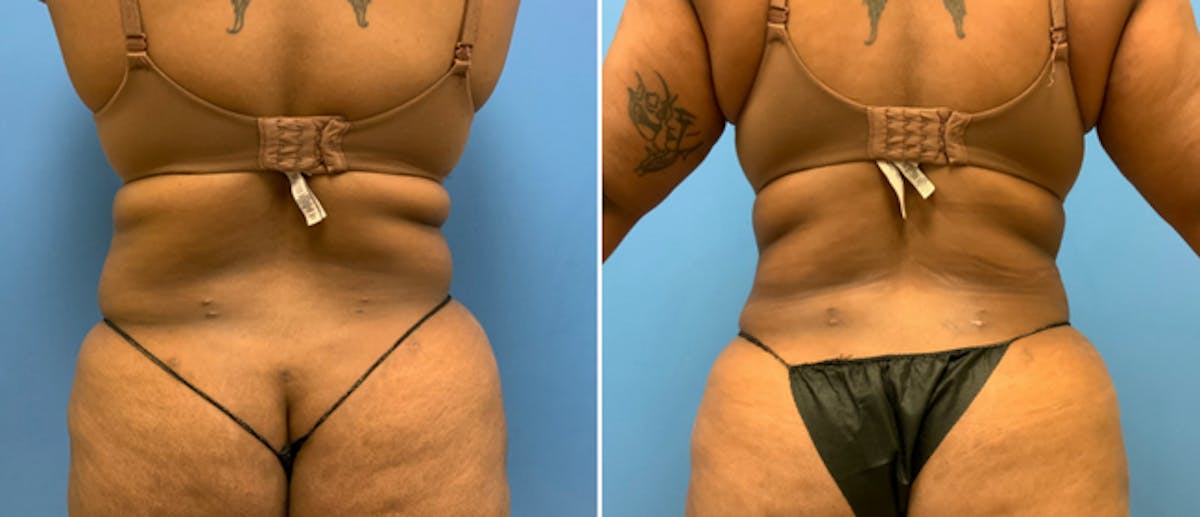 Liposuction Before & After Gallery