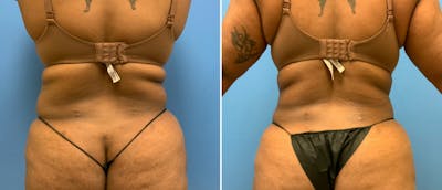 Liposuction Before & After Gallery - Patient 38566558 - Image 1