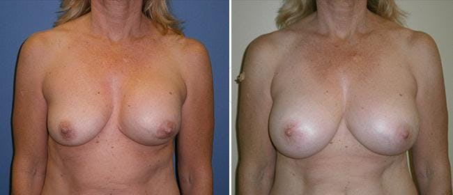 Breast Augmentation Before & After Gallery - Patient 38566561 - Image 1