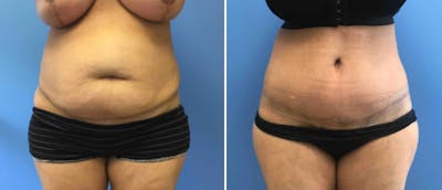 Tummy Tuck Before & After Gallery - Patient 38566562 - Image 1