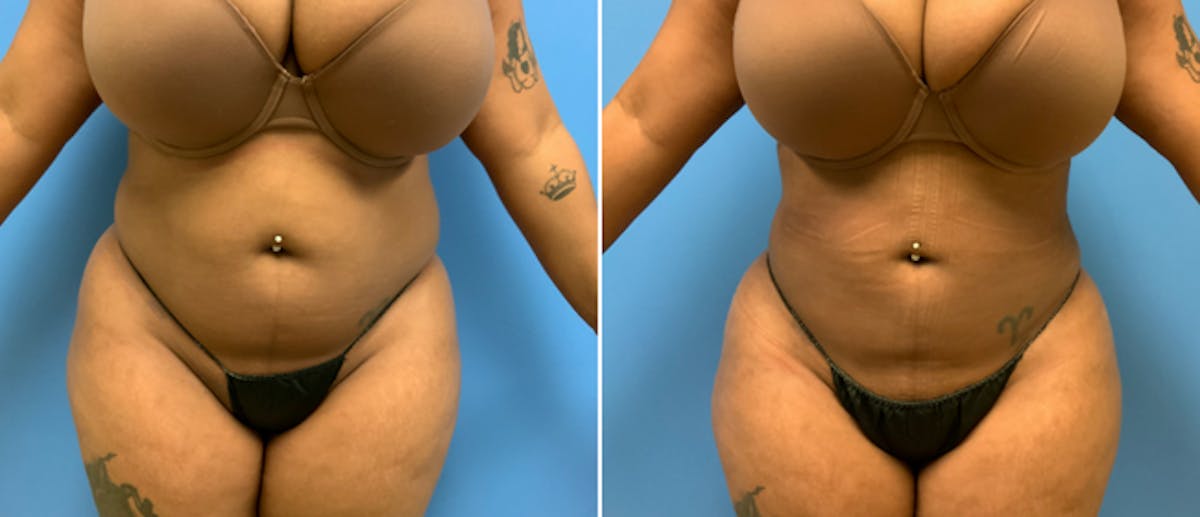 Liposuction Before & After Gallery - Patient 38566558 - Image 2