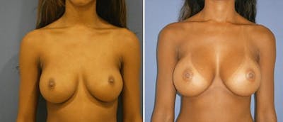 Breast Augmentation Before & After Gallery - Patient 38566564 - Image 1