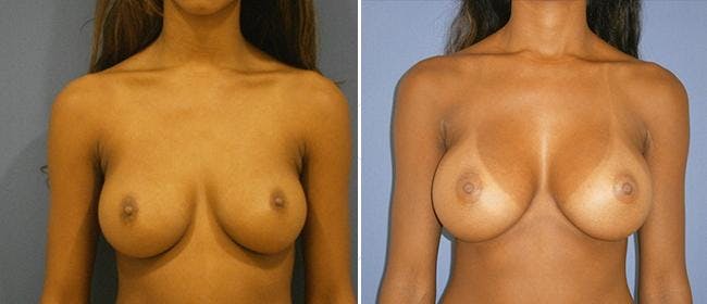 Breast Augmentation Before & After Gallery - Patient 38566564 - Image 1