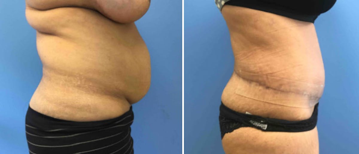 Tummy Tuck Before & After Gallery - Patient 38566562 - Image 2