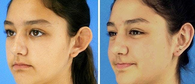 Ear Surgery Before & After Gallery - Patient 38566567 - Image 1