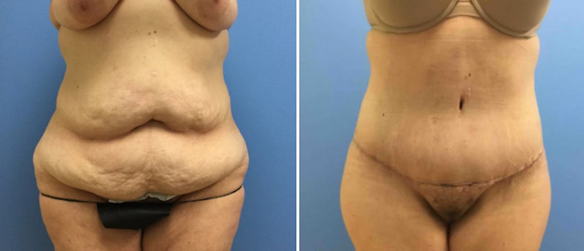 Abdominoplasty (Tummy Tuck) Before & After Gallery - Patient 38566569 - Image 1