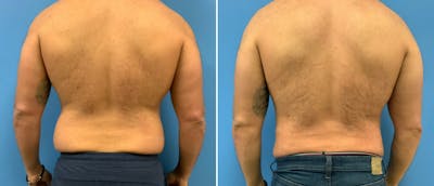 Liposuction / Bodytite Before & After Gallery - Patient 38566570 - Image 1
