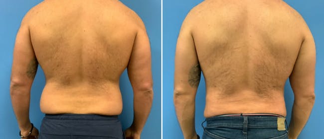 Liposuction Before & After Gallery - Patient 38566570 - Image 1