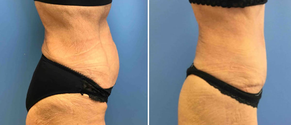 Tummy Tuck Before & After Gallery - Patient 38566573 - Image 2