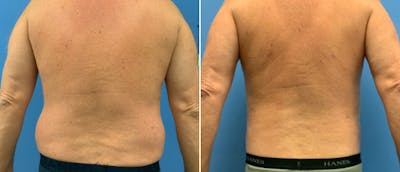 Liposuction / Bodytite Before & After Gallery - Patient 38566575 - Image 1