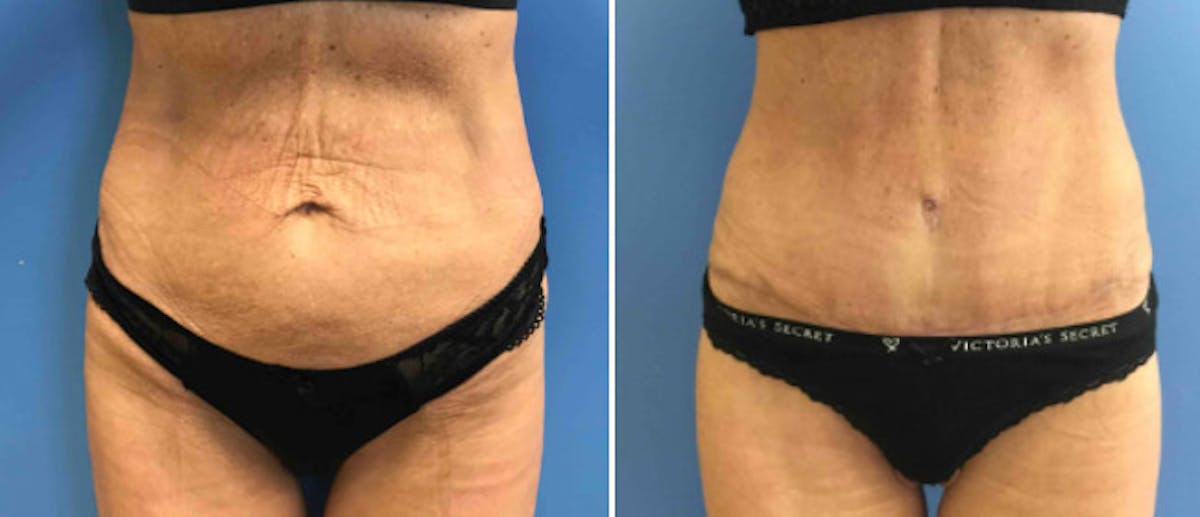 Tummy Tuck Before & After Gallery - Patient 38566573 - Image 1