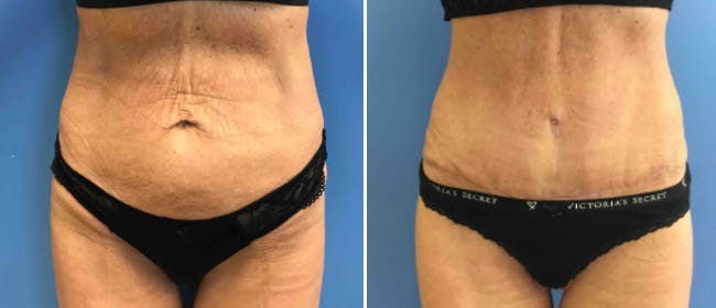 Abdominoplasty (Tummy Tuck) Before & After Gallery - Patient 38566573 - Image 1
