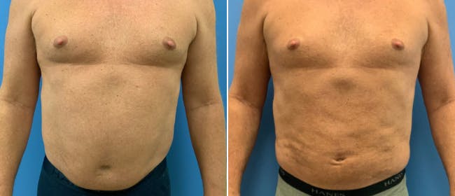 Liposuction Before & After Gallery - Patient 38566575 - Image 2