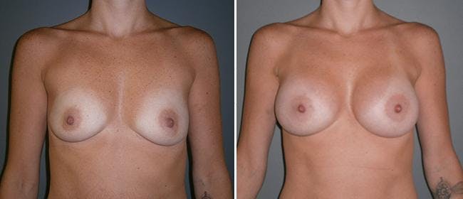 Breast Augmentation Before & After Gallery - Patient 38566579 - Image 1
