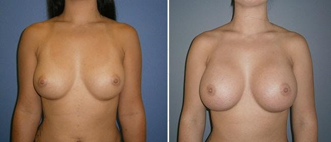 Breast Augmentation Before & After Gallery - Patient 38566582 - Image 1