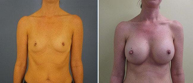 Breast Augmentation Before & After Gallery - Patient 38566585 - Image 1