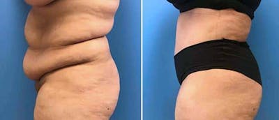 Tummy Tuck Before & After Gallery - Patient 38566587 - Image 1
