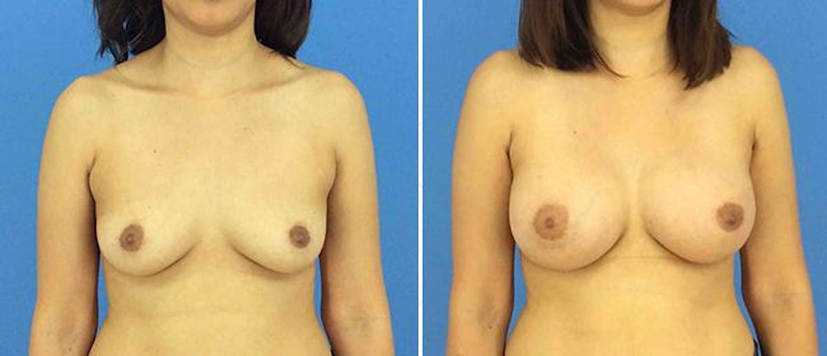 Breast Augmentation Before & After Gallery - Patient 38566588 - Image 1