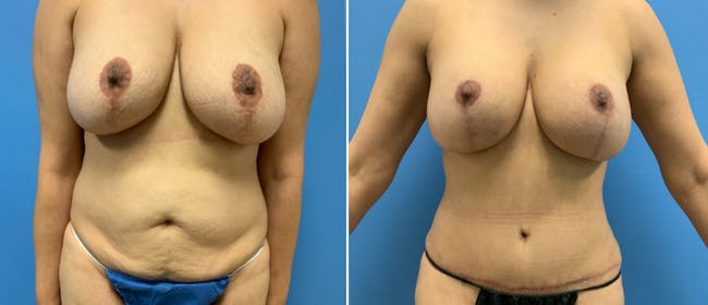 Liposuction Before & After Gallery - Patient 38566583 - Image 3