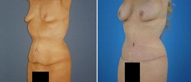 Abdominoplasty (Tummy Tuck) Before & After Gallery - Patient 38566589 - Image 1