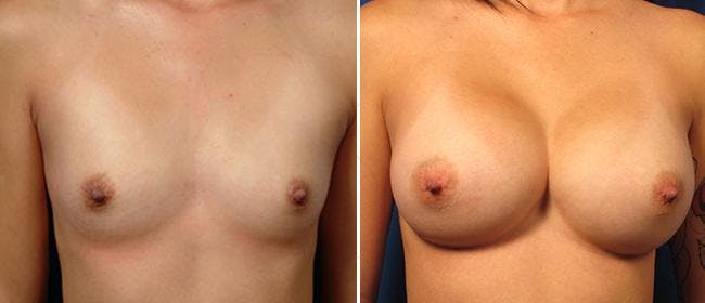 Breast Augmentation Before & After Gallery - Patient 38566592 - Image 1