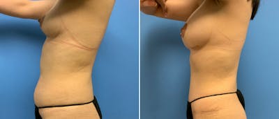 Liposuction Before & After Gallery - Patient 38566596 - Image 1