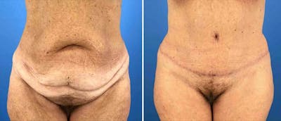 Tummy Tuck Before & After Gallery - Patient 38566597 - Image 1