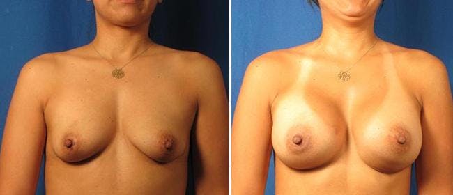 Breast Augmentation Before & After Gallery - Patient 38566598 - Image 1