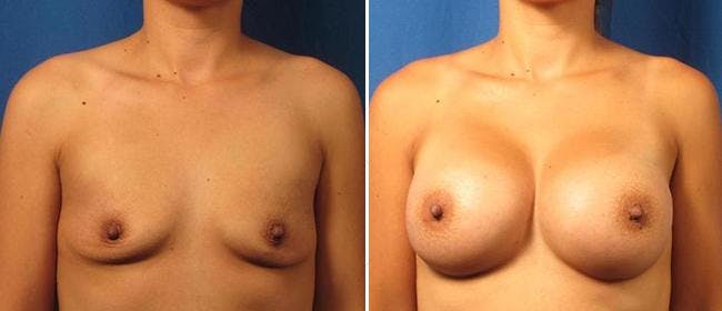 Breast Augmentation Before & After Gallery - Patient 38566602 - Image 1