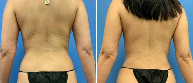 Liposuction Before & After Gallery - Patient 38566596 - Image 3