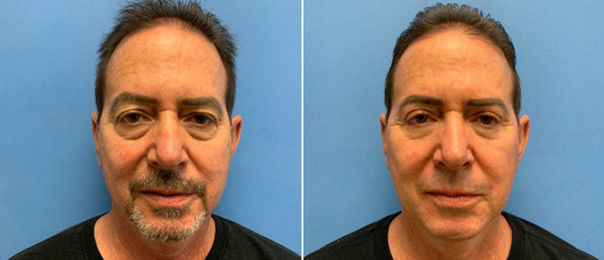 Eyelid Surgery Before & After Gallery - Patient 38566605 - Image 1