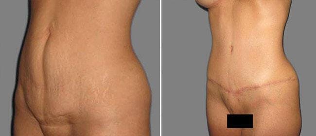 Abdominoplasty (Tummy Tuck) Before & After Gallery - Patient 38566604 - Image 1