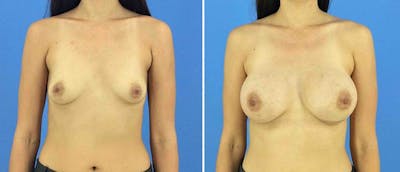 Breast Augmentation Before & After Gallery - Patient 38566606 - Image 1