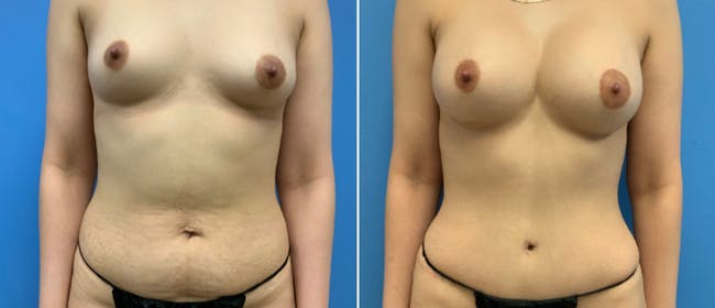 Liposuction Before & After Gallery - Patient 38566596 - Image 4