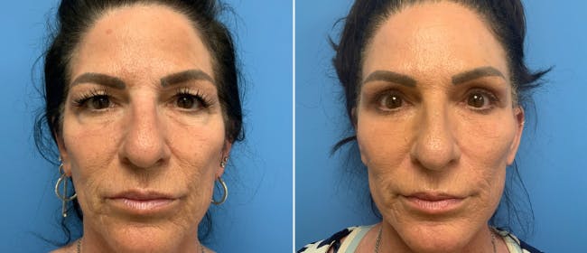 Eyelid Surgery Before & After Gallery - Patient 38566609 - Image 1
