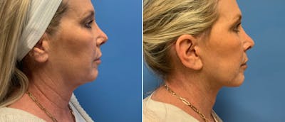 Facelift Before & After Gallery - Patient 38566611 - Image 1