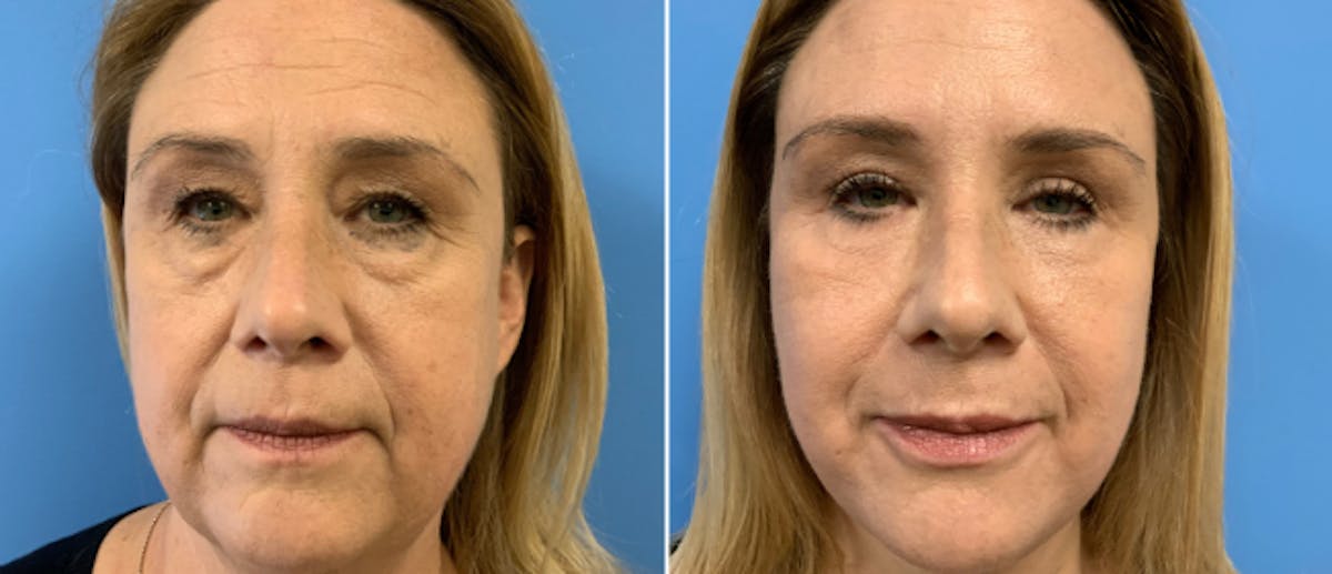 Eyelid Surgery Before & After Gallery - Patient 38566618 - Image 1