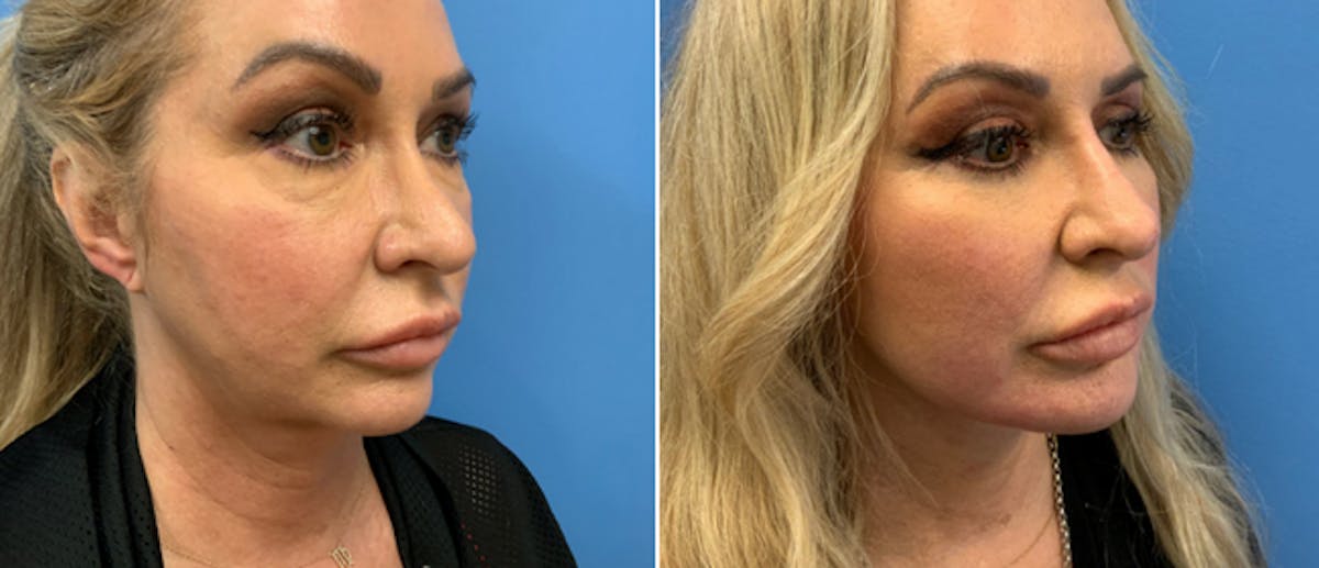 Facelift Before & After Gallery - Patient 38566617 - Image 1