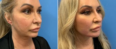 Facelift Before & After Gallery - Patient 38566617 - Image 1