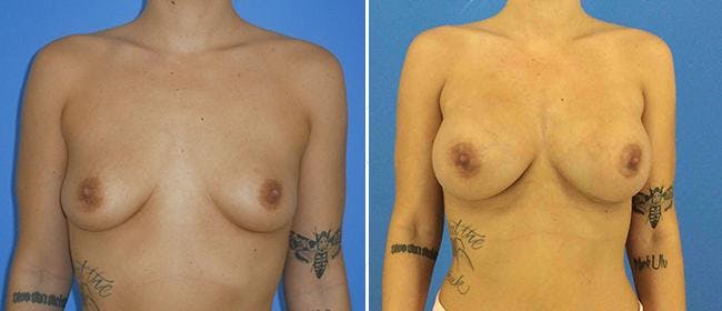 Breast Augmentation Before & After Gallery - Patient 38566615 - Image 1