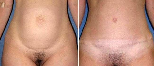 Abdominoplasty (Tummy Tuck) Before & After Gallery - Patient 38566619 - Image 1