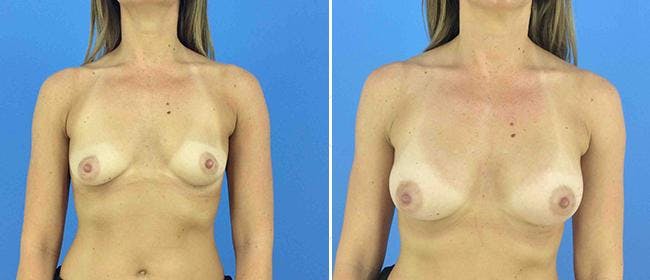 Breast Augmentation Before & After Gallery - Patient 38566620 - Image 1