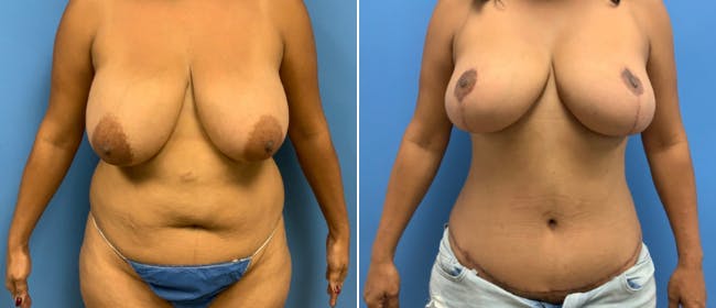 Liposuction Before & After Gallery - Patient 38566612 - Image 3