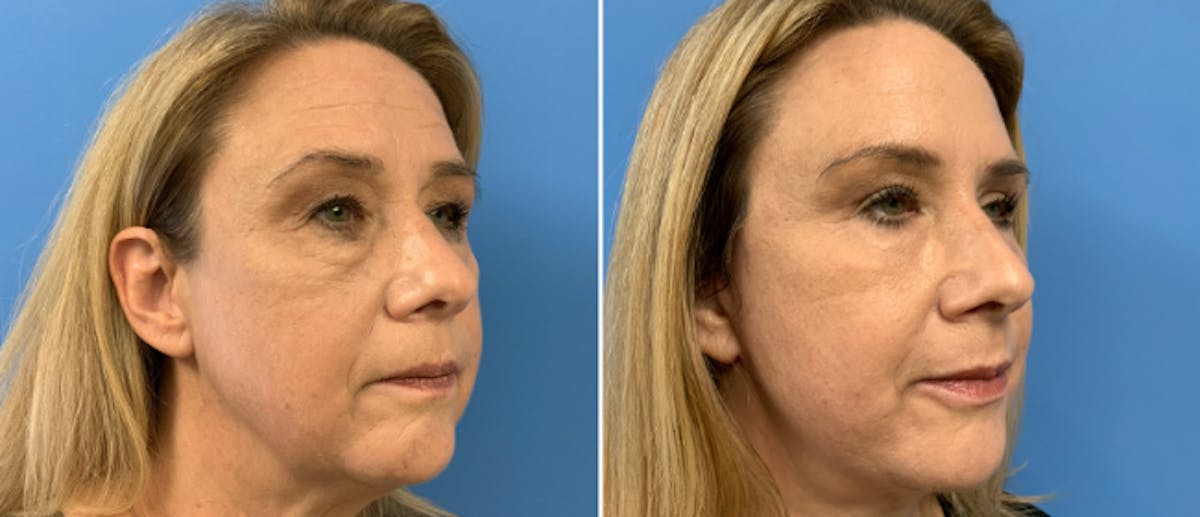Eyelid Surgery Before & After Gallery - Patient 38566618 - Image 2