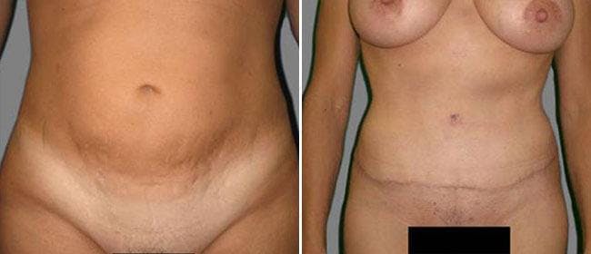 Abdominoplasty (Tummy Tuck) Before & After Gallery - Patient 38566624 - Image 1