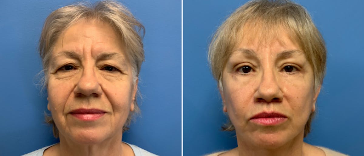 Eyelid Surgery Before & After Gallery - Patient 38566627 - Image 1