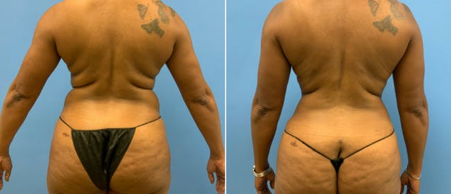 Liposuction Before & After Gallery - Patient 38566628 - Image 1