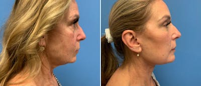 Facelift Before & After Gallery - Patient 38566629 - Image 1